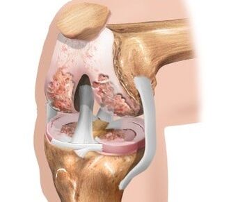 Le cartilage est sur le genou