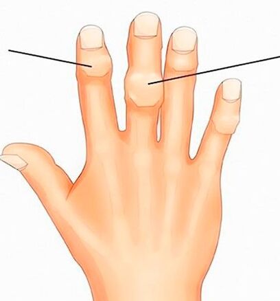 Nodules d'Heberden et de Bouchard dans les articulations interphalangiennes avec arthrose