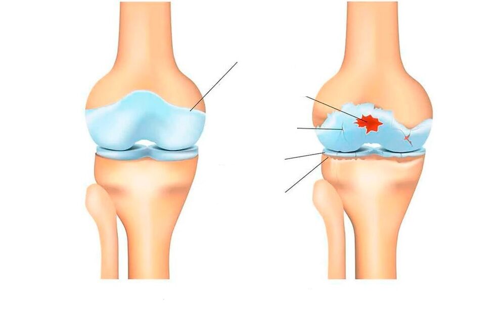 articulation saine et arthrosique