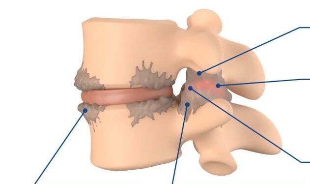 modifications tissulaires dans la spondylarthrose