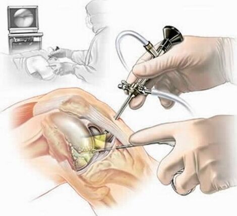 Fonctionnement des articulations du genou - Arthroscopie