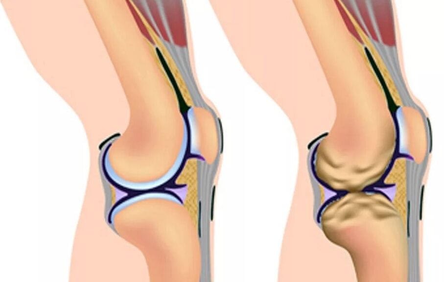 Le premier degré d'arthrose du genou