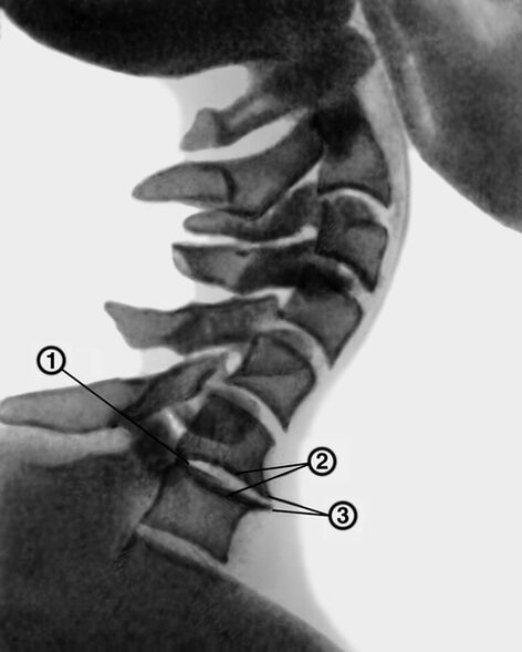 Radiographie de la colonne cervicale avec ostéochondrose.