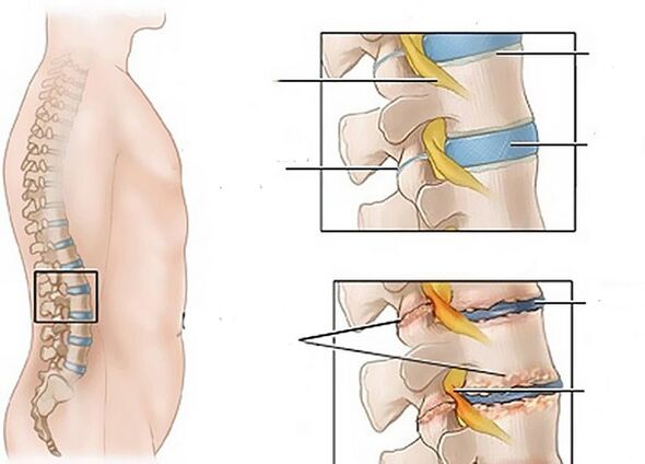 Modifications des disques dues à l'ostéochondrose.